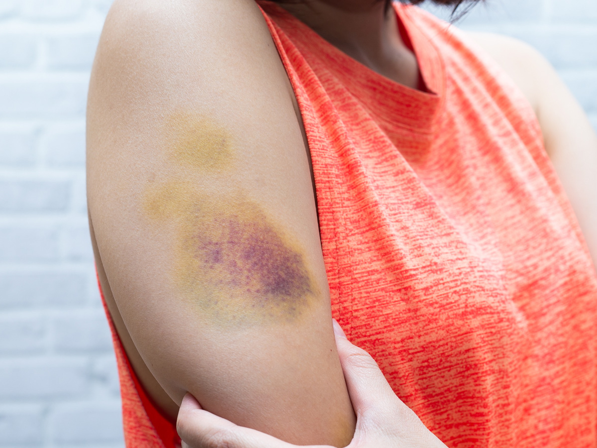 home remedies for bruises