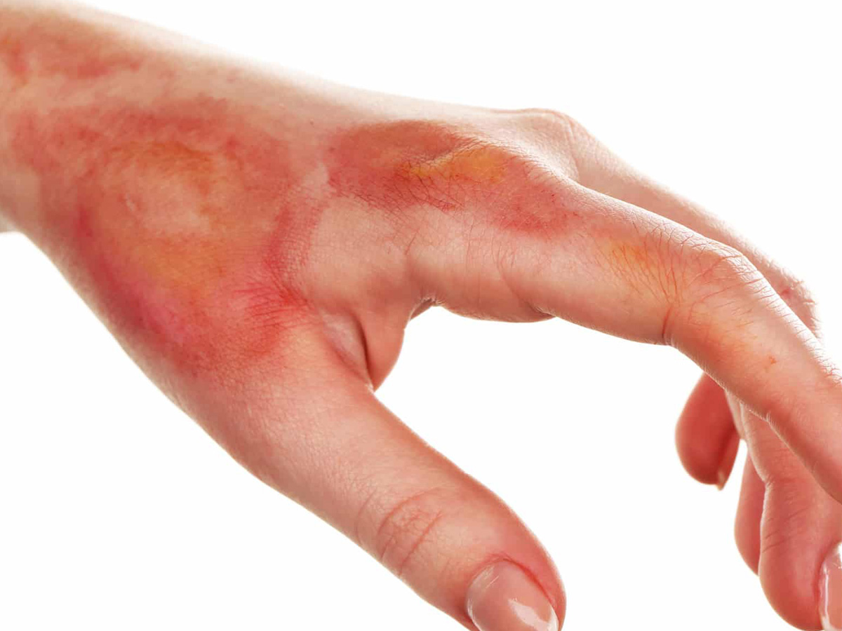 home remedies for burns